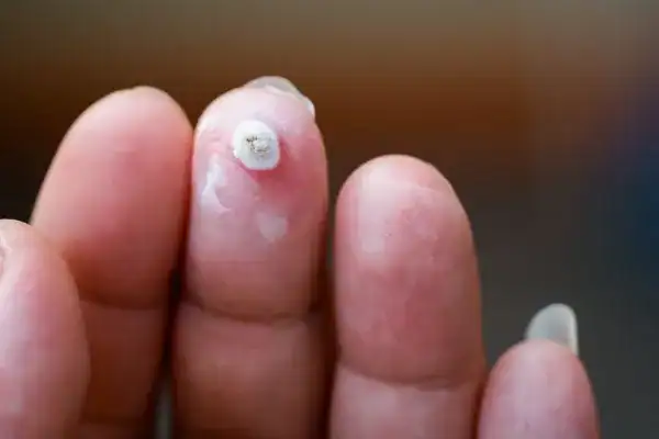 Image of white wart before cryopen treatment Whitstable