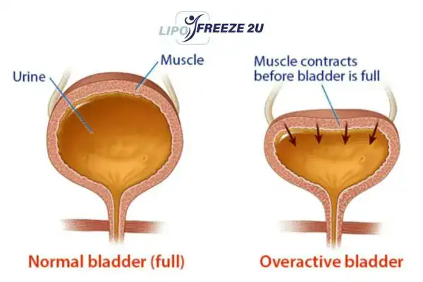 diagram of overactive bladder treatment Whitstable