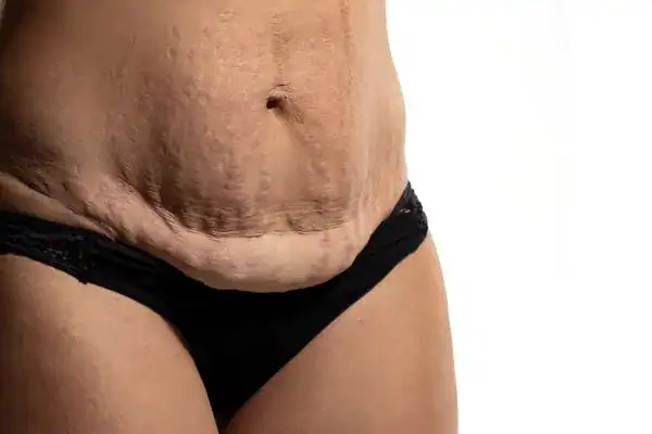 loose skin after weight loss injections Whitstable