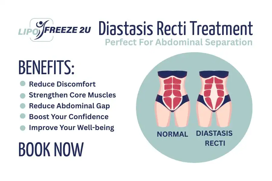 Benefits of body toning treatment Whitstable for Diastasis recti