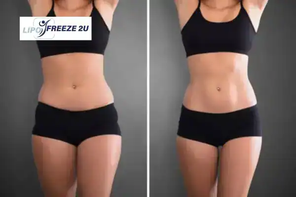 How Can LIPO FREEZE 2U Support Your Post-Pregnancy Body Recovery Whitstable?