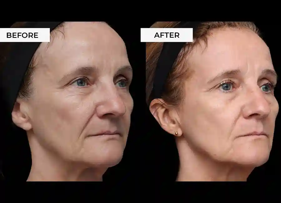 How Many RF Microneedling Sessions Will You Need to See a Difference Whitstable?
