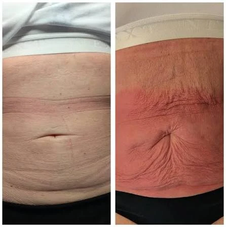How Does RF Microneedling Improve Crepey, Thin and Uneven Skin Texture Whitstable?