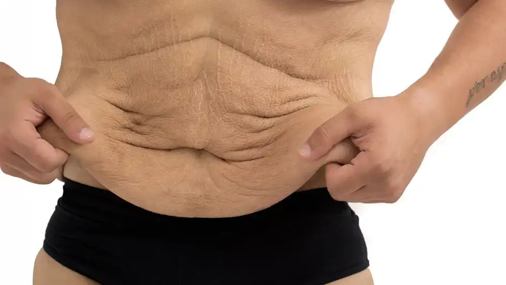 RF Microneedling for Loose Skin: How Can It Help Tighten and Reshape the Skin Whitstable?